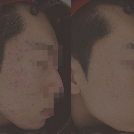 여드름 자국, 흉터 치료는 초기부터!