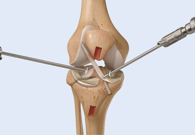 관절 내시경 수술