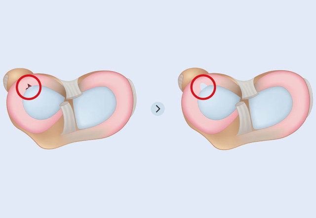 반월상 연골 절제술