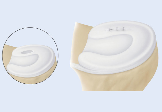 반월상 연골 봉합술