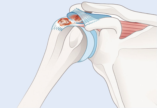관절경 석회 제거술