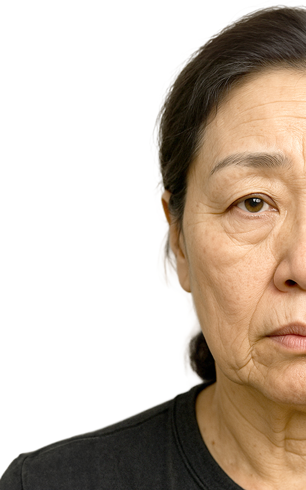 before - 부산 서면 리프트리 성형외과