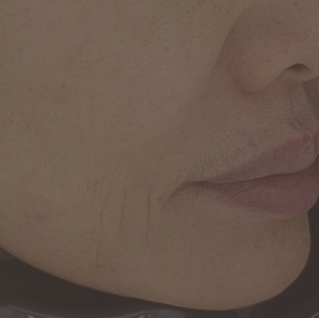 입가 잔주름! 주름 필러 시술 전후 보기