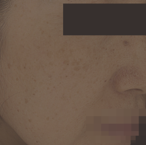 얼굴의 잡티, 흑자제거 어떻게 치료할까요?