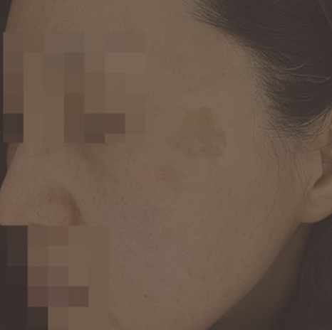 거대 흑자 제거도 됩니다!