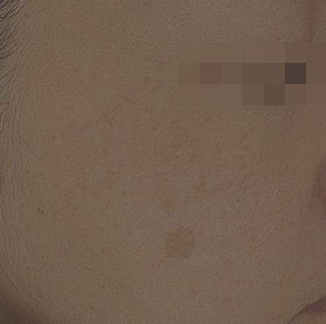 기미, 주근깨, 잡티는 서로 어떻게 다를까요?