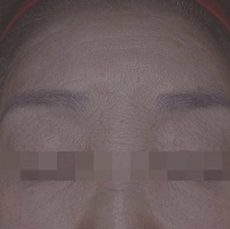 얼굴 잔주름 지우는 방법!  이마, 콧등, 눈가 주름을 말끔하게 펴고 싶다면?