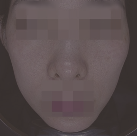 마른 얼굴  쥬베룩 전, 후 비교