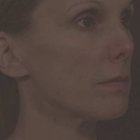 꺼진 볼살, 마른 얼굴은 스컬트라로 채우자!