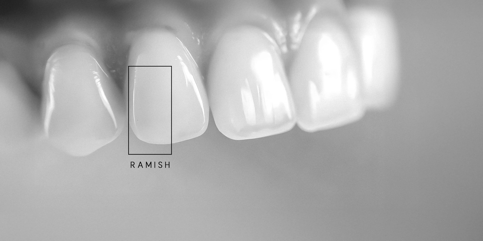 은계치과-시흥은행동치과-클리어치과-무삭제라미쉬-치료대상