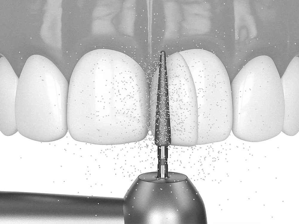 은계치과-시흥은행동치과-클리어치과-앞니레진치료과정-표면다듬기,완성