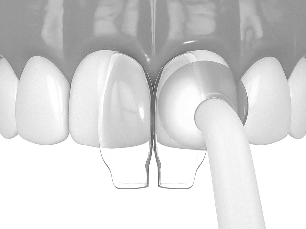 은계치과-시흥은행동치과-클리어치과-앞니레진치료과정-레진경화