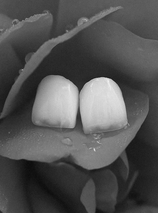 은계치과-시흥은행동치과-클리어치과-앞니레진치료소개