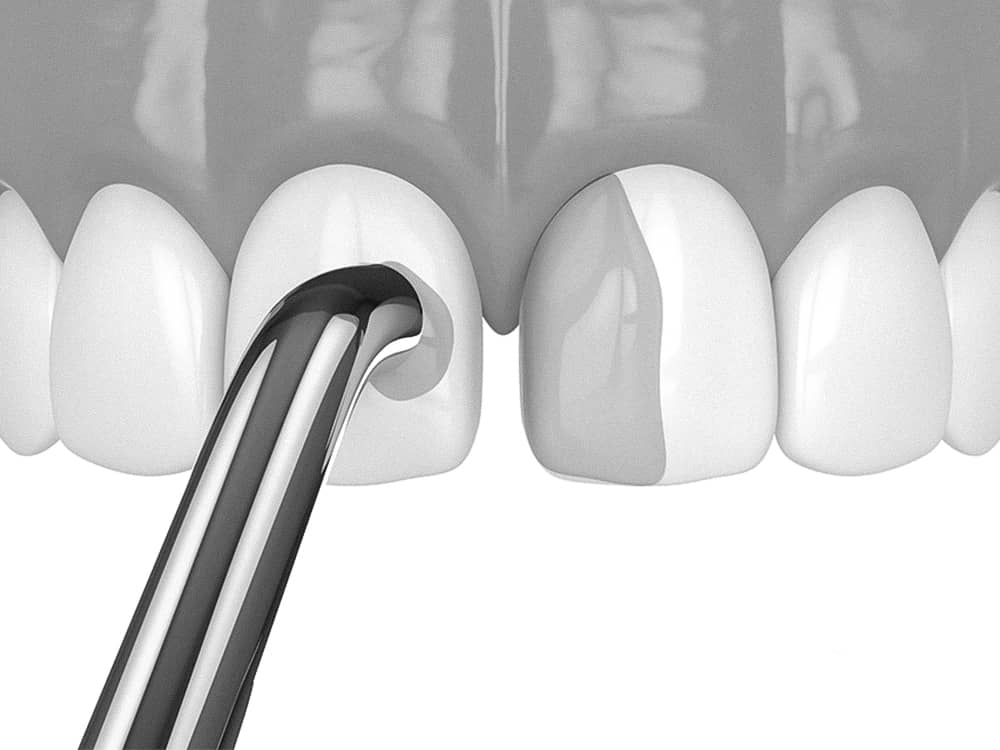 은계치과-시흥은행동치과-클리어치과-앞니레진치료과정-치아표면처리
