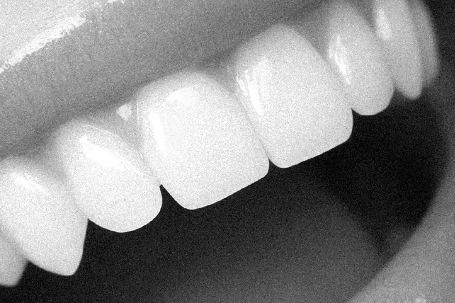 은계치과-시흥은행동치과-클리어치과-앞니레진치료장점