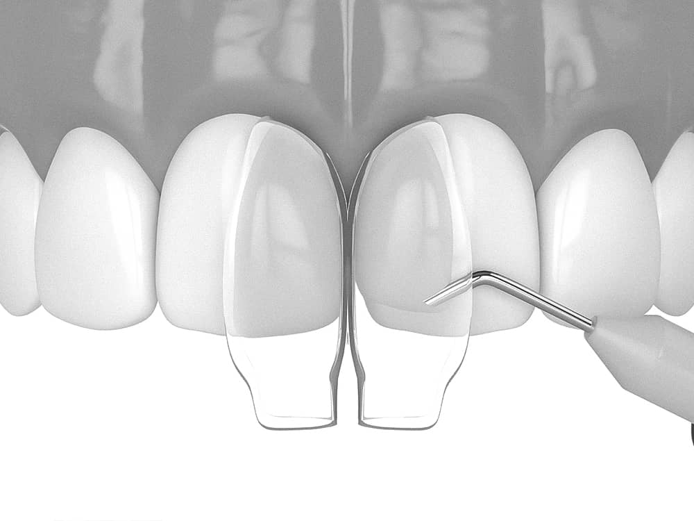 은계치과-시흥은행동치과-클리어치과-앞니레진치료과정-레진도포