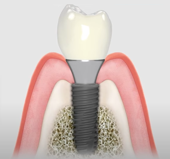접착제를 사용하지 않아 합병증으로부터 안전