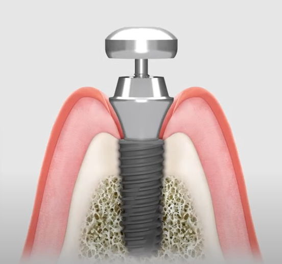 잇몸 자극 및 통증 최소화