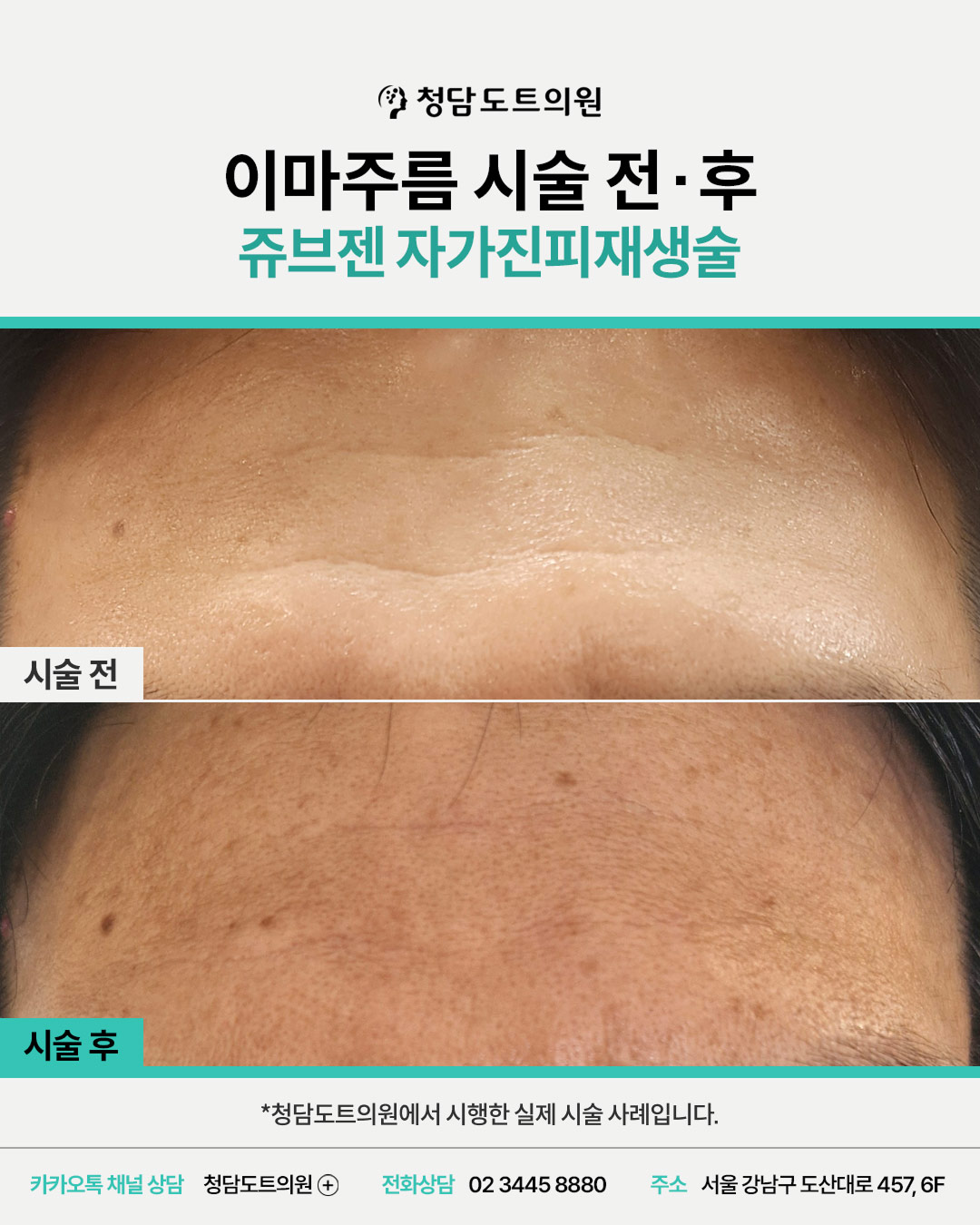 청담도트의원 쥬브젠 이마주름 시술 전후