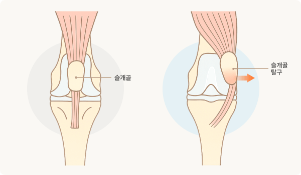 슬개골 탈구
