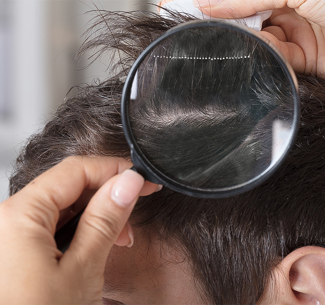 Scalp hair <br>loss care