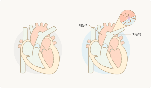 PDA (동맥관 개존증)