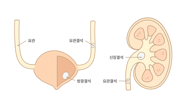 요로결석