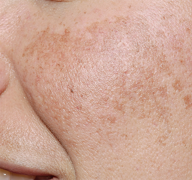 Freckles and <br>elasticity care