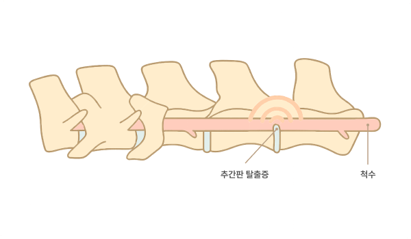 척수손상