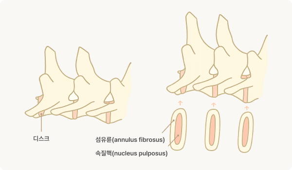 섬유연골색전증 (척수경색)