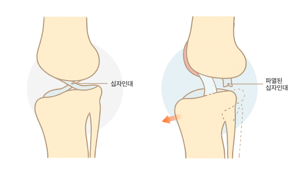 전십자인대 단열