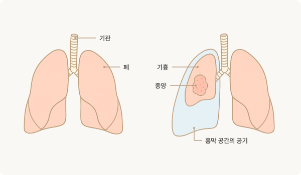 폐종양