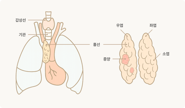 흉선종