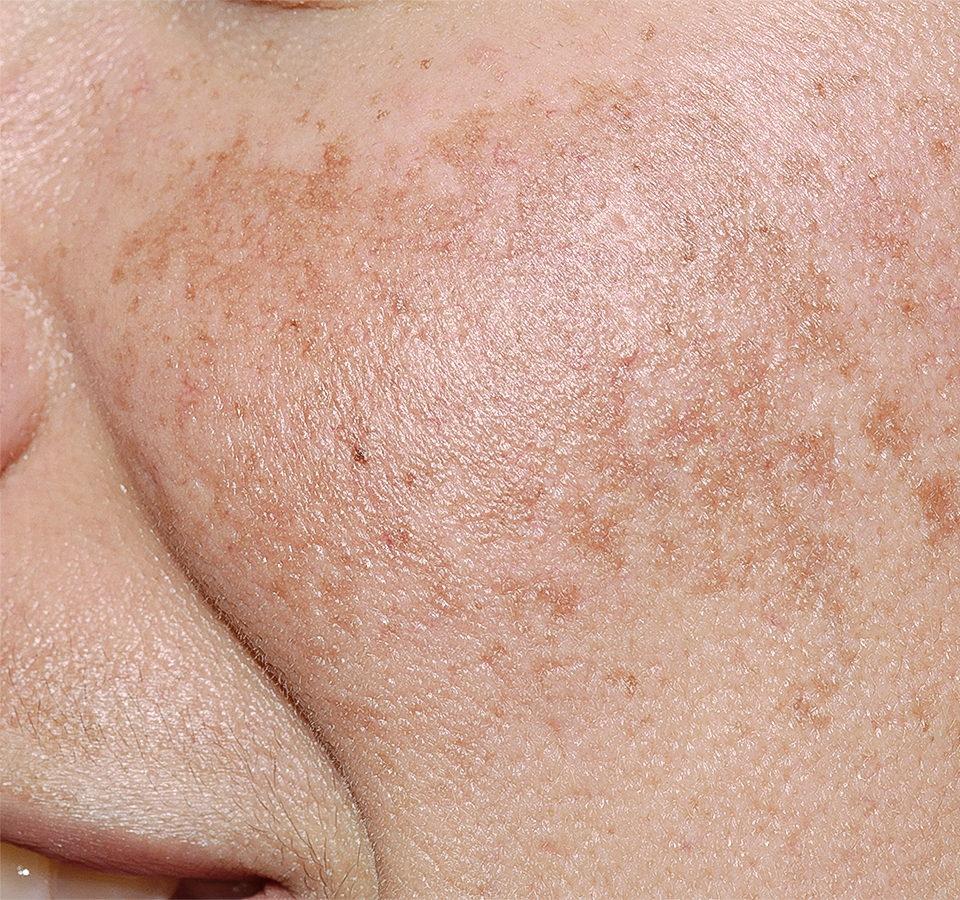 Freckles and <br>elasticity care