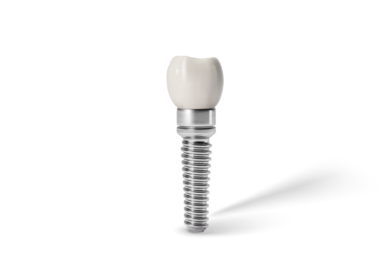 디지털임플란트