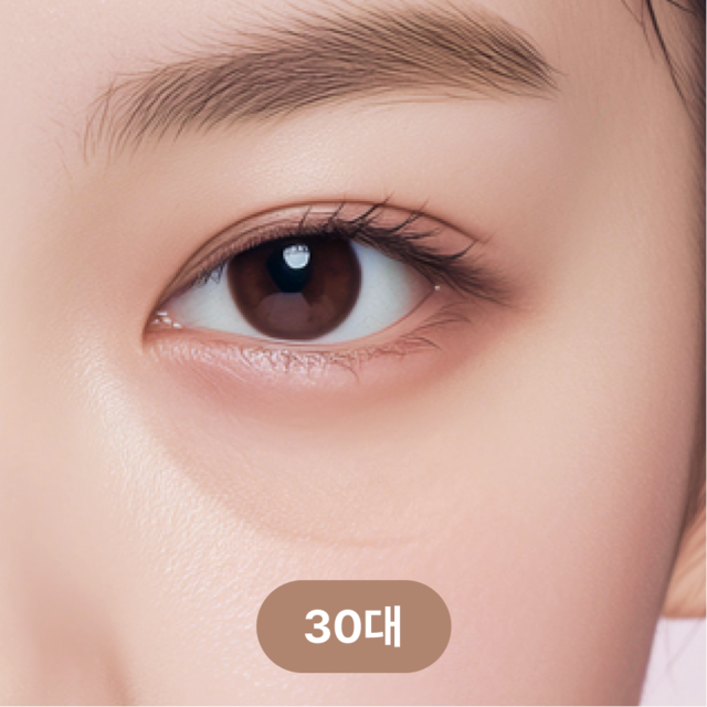 <p style="margin-top:40px;line-height:1.5;"><span style="color: rgb(102, 102, 102); font-size: 20px;">안와지방이 점점 돌출되어 눈물고랑이 꺼져 보임</span></p>