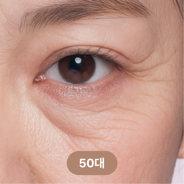 <p style="margin-top:40px;line-height:1.5;"><span style="color: rgb(102, 102, 102); font-size: 20px;">눈물고랑 피부가 변색되고 심하게 피곤해 보임</span></p>