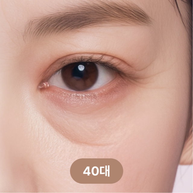 <p style="margin-top:40px;line-height:1.5;"><span style="color: rgb(102, 102, 102); font-size: 20px;">안와지방이 처지고 눈물고랑이 또렷해짐</span></p>