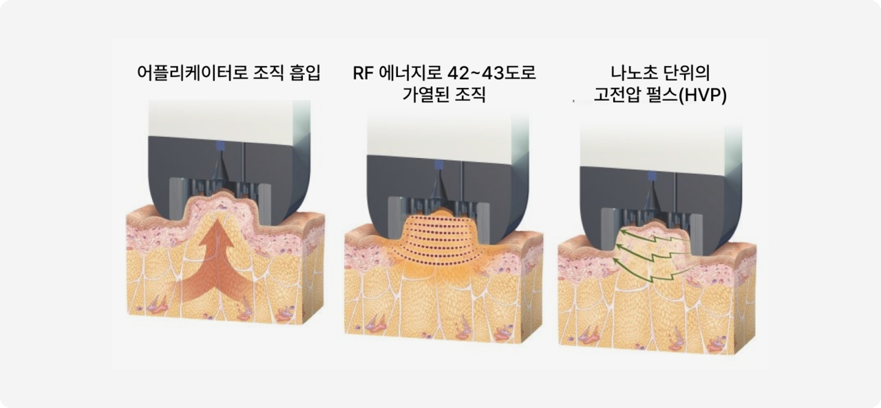 인모드, INMODE의 원리 설명