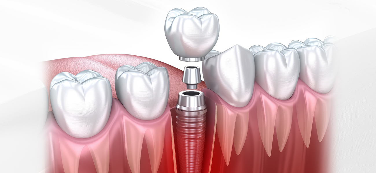 서울수치과 임플란트재수술 재수술임플란트 임플란트탈락 임플란트빠짐