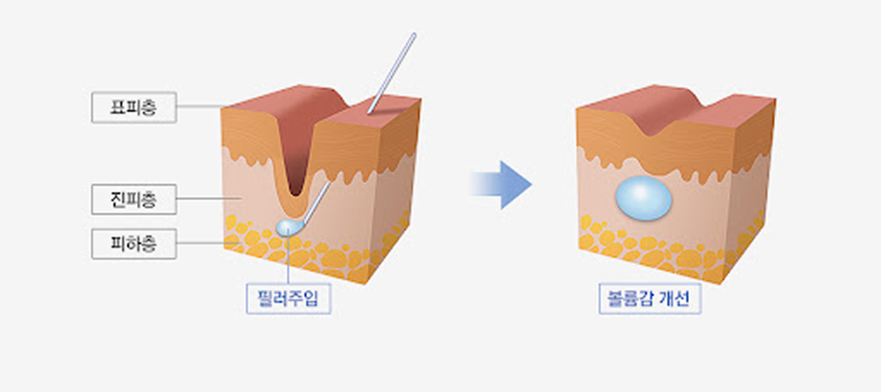 필러의 효과, 효능, 원리, 개념 설명
