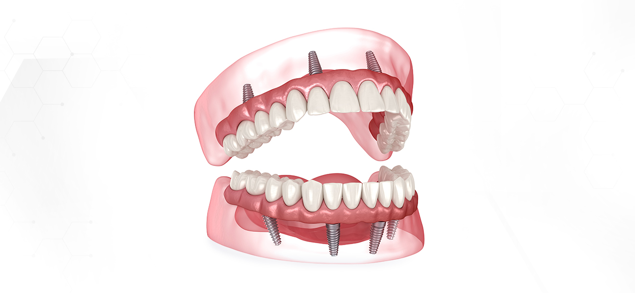 서울수치과 임플란트틀니 임플란트보험 틀니보험 치과건강보험