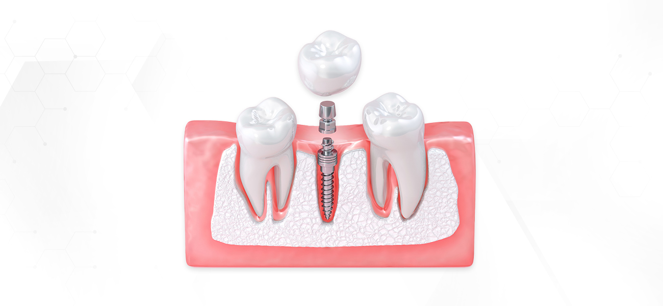 서울수치과 고난이도임플란트 뼈이식임플란트