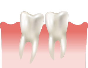 사랑니 비스듬히 자라는 경우