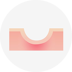 롤링 흉터에 대한 설명