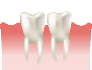 사랑니가 올바르게 난 경우 상황에 따라 발치