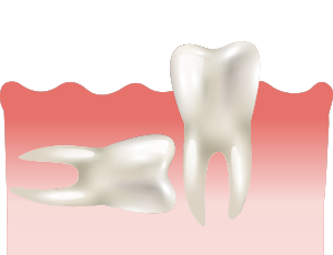 사랑니가 누워서 자라는 경우