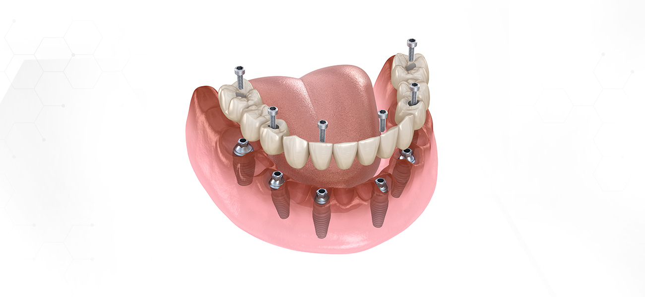 서울수치과 풀아치임플란트 전악임플란트 풀마우스