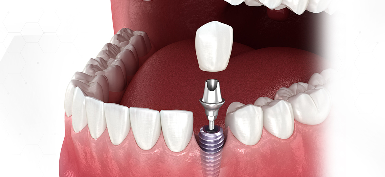 서울수치과 임플란트관리 임플란트실패방지 임플란트사후관리