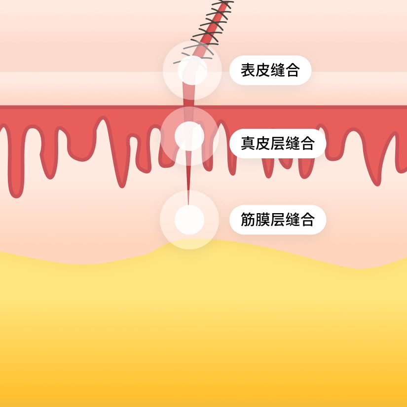 suture-img